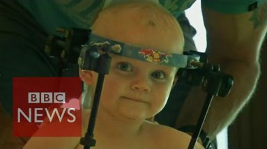Toddler’s head re-linked to backbone – BBC News