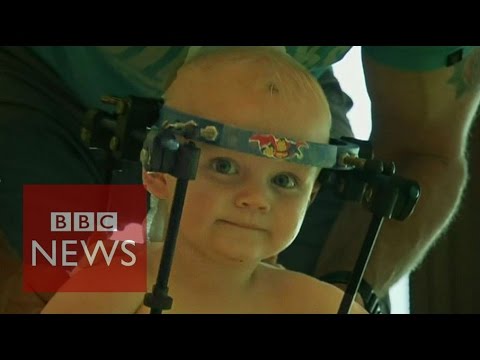 Toddler’s head re-linked to backbone – BBC News