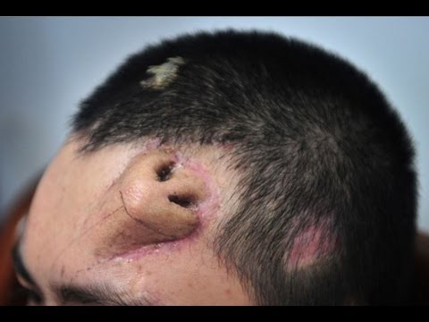 CHINA MAN GROWS A NOSE ON HIS FOREHEAD BBC NEWS