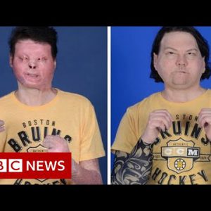 First a success face and double hand transplant – BBC News