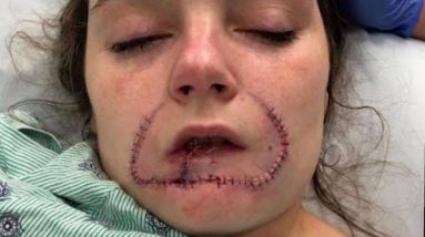 Lady Gets Surgical treatment to Restore Lip Her Ex-Boyfriend Bit Off