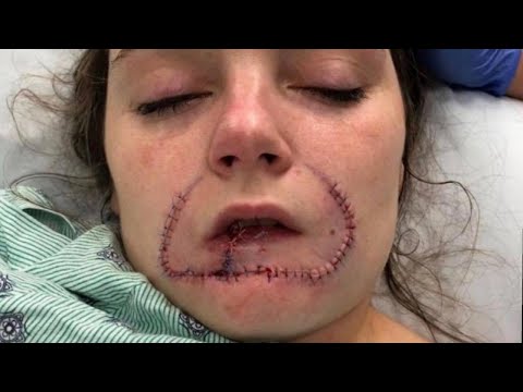 Lady Gets Surgical treatment to Restore Lip Her Ex-Boyfriend Bit Off