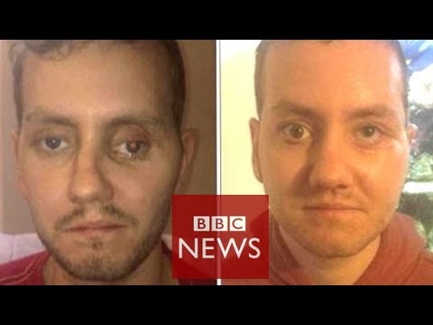 ‘3D printer helped rebuild my face’ – BBC Records