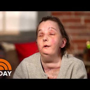 Girl Who Bought Face Transplant Meets Donor’s Family | TODAY