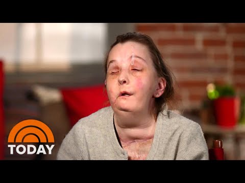 Girl Who Bought Face Transplant Meets Donor’s Family | TODAY